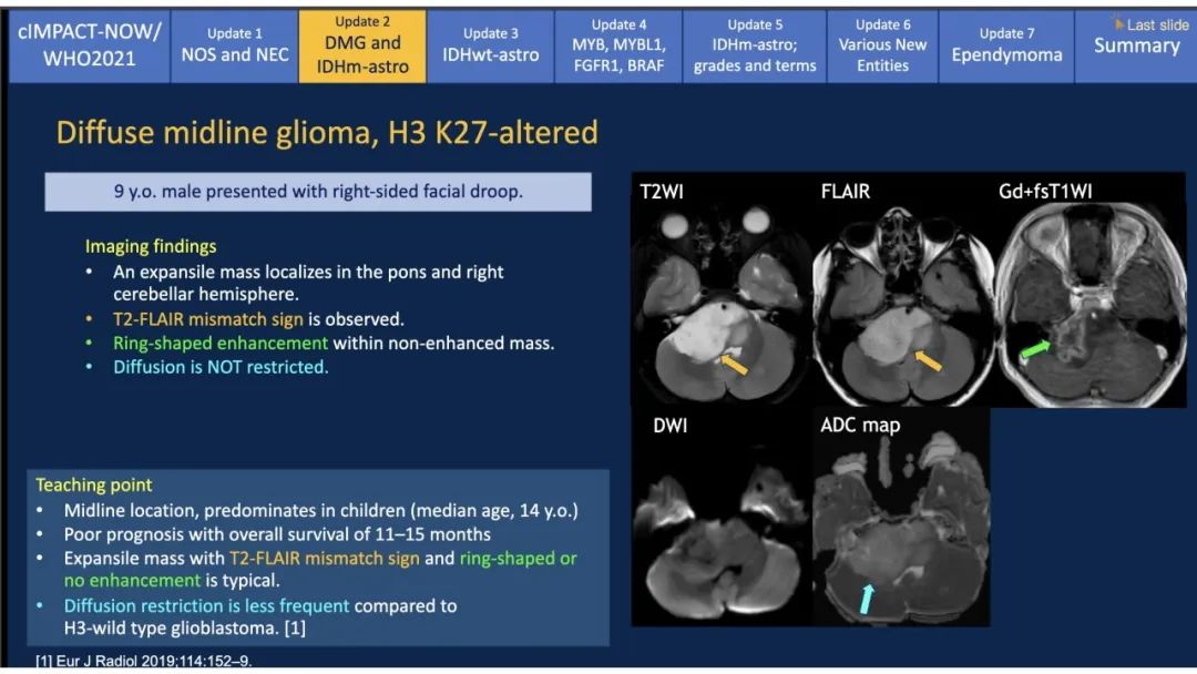 【PPT】中枢神经系统肿瘤的MRI表现：随cIMPACT-NOW一同展望WHO2021分类-13