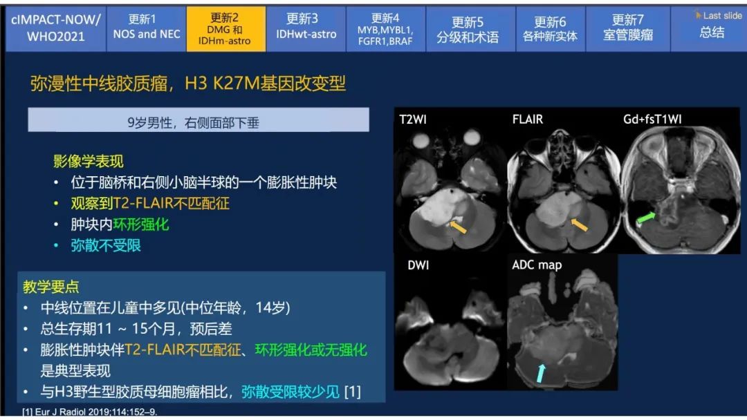 【PPT】中枢神经系统肿瘤的MRI表现：随cIMPACT-NOW一同展望WHO2021分类-14