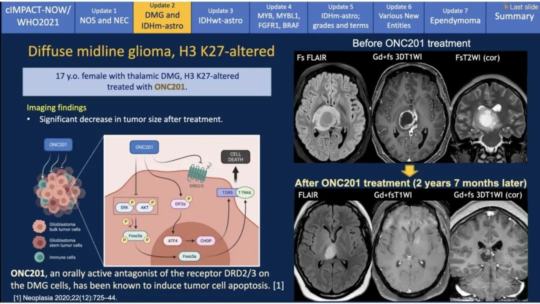 【PPT】中枢神经系统肿瘤的MRI表现：随cIMPACT-NOW一同展望WHO2021分类-15