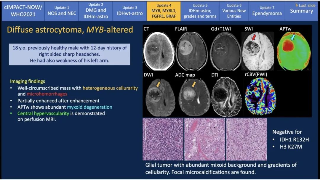 【PPT】中枢神经系统肿瘤的MRI表现：随cIMPACT-NOW一同展望WHO2021分类-25