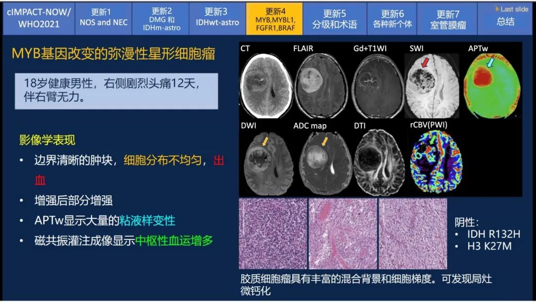 【PPT】中枢神经系统肿瘤的MRI表现：随cIMPACT-NOW一同展望WHO2021分类-26