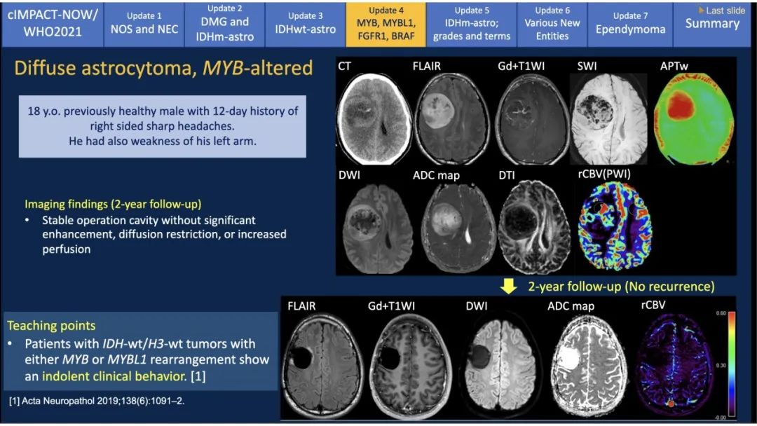 【PPT】中枢神经系统肿瘤的MRI表现：随cIMPACT-NOW一同展望WHO2021分类-27
