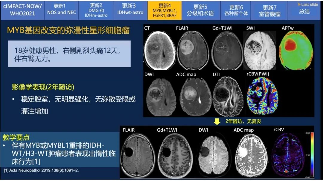 【PPT】中枢神经系统肿瘤的MRI表现：随cIMPACT-NOW一同展望WHO2021分类-28