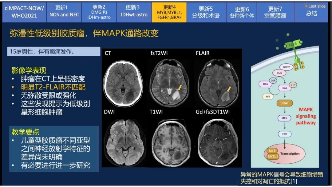 【PPT】中枢神经系统肿瘤的MRI表现：随cIMPACT-NOW一同展望WHO2021分类-30