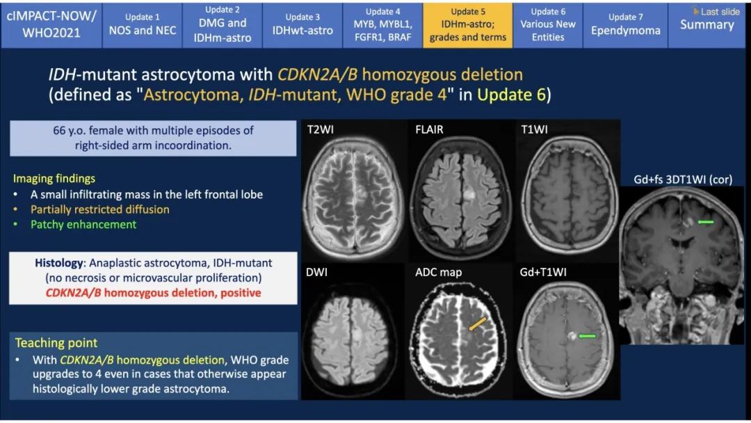 【PPT】中枢神经系统肿瘤的MRI表现：随cIMPACT-NOW一同展望WHO2021分类-33