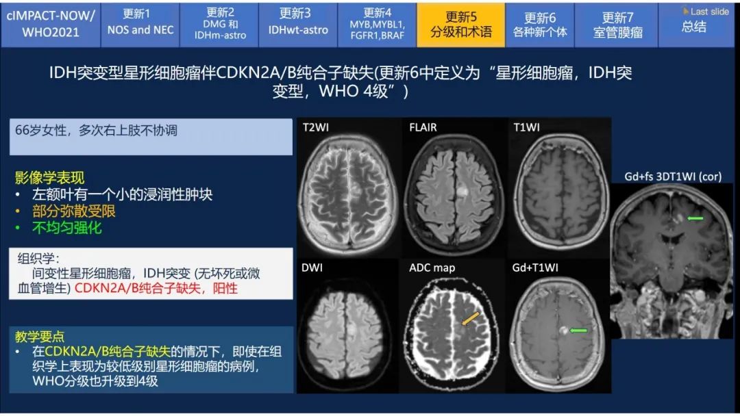 【PPT】中枢神经系统肿瘤的MRI表现：随cIMPACT-NOW一同展望WHO2021分类-34