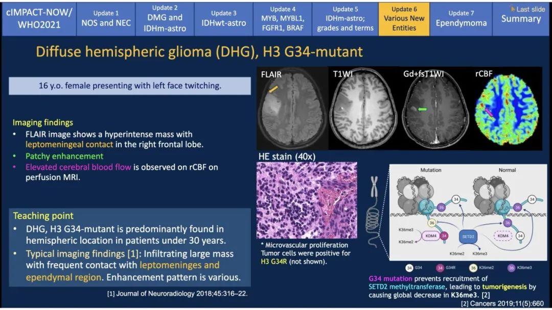 【PPT】中枢神经系统肿瘤的MRI表现：随cIMPACT-NOW一同展望WHO2021分类-37
