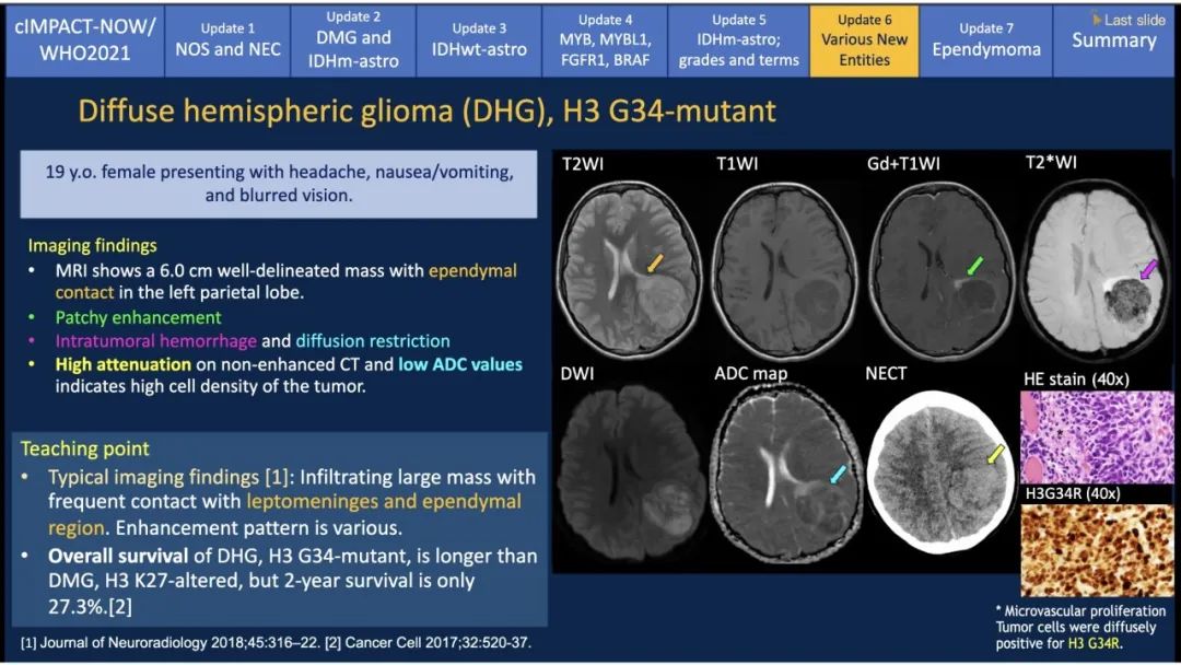 【PPT】中枢神经系统肿瘤的MRI表现：随cIMPACT-NOW一同展望WHO2021分类-39