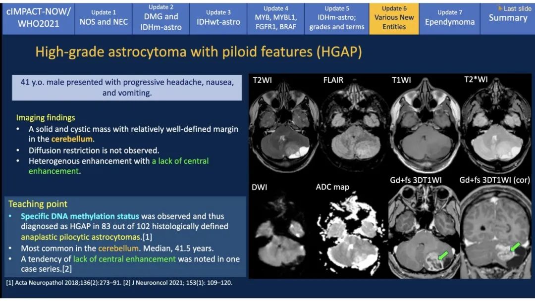 【PPT】中枢神经系统肿瘤的MRI表现：随cIMPACT-NOW一同展望WHO2021分类-41