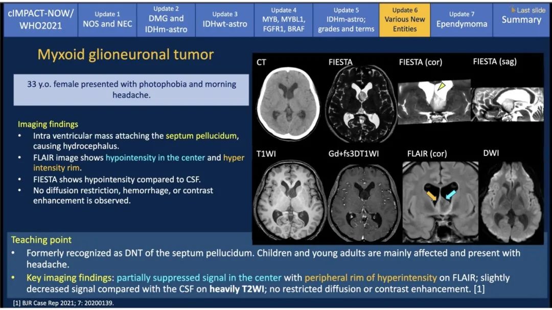 【PPT】中枢神经系统肿瘤的MRI表现：随cIMPACT-NOW一同展望WHO2021分类-43
