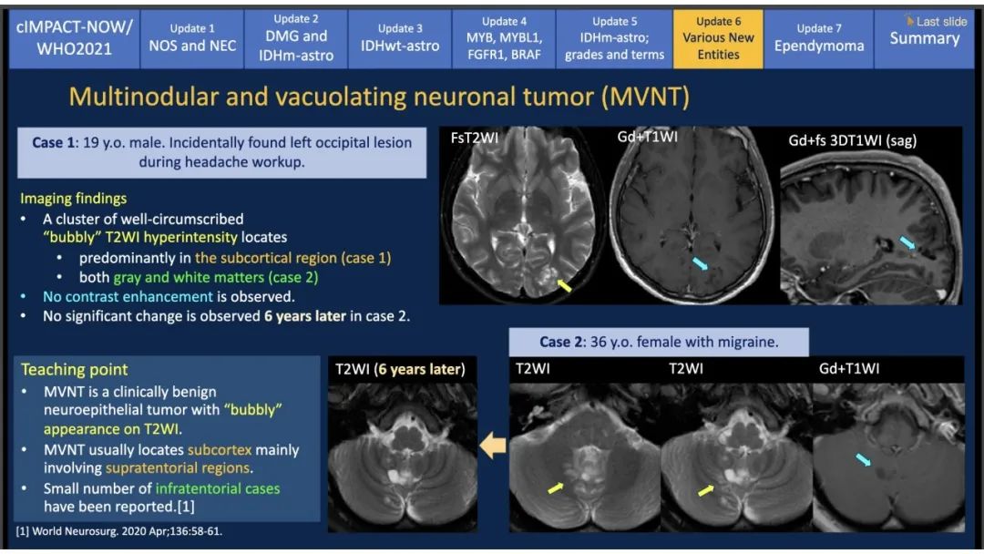 【PPT】中枢神经系统肿瘤的MRI表现：随cIMPACT-NOW一同展望WHO2021分类-47