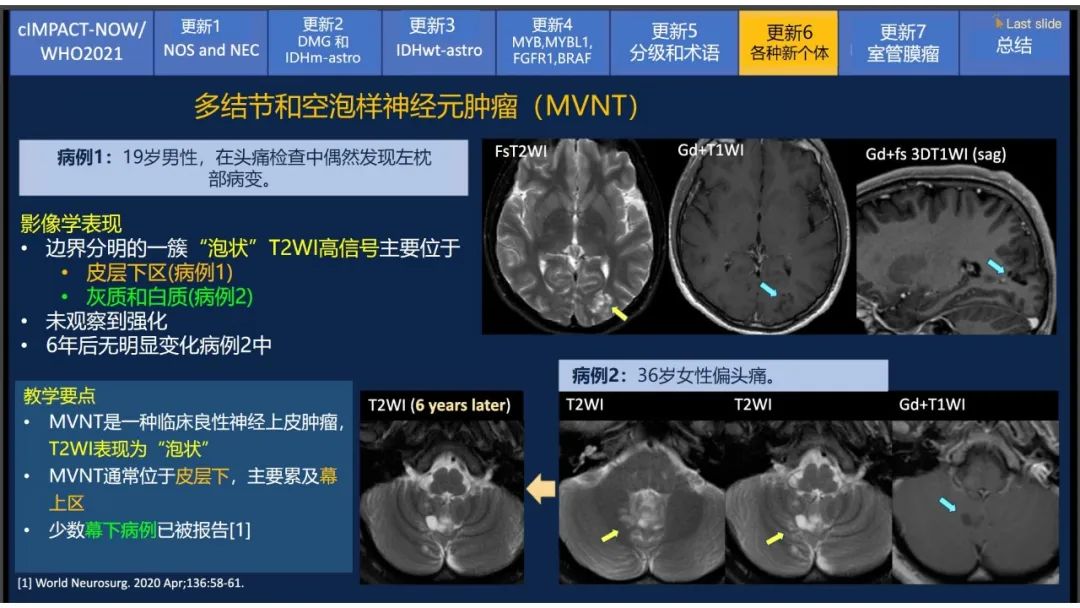 【PPT】中枢神经系统肿瘤的MRI表现：随cIMPACT-NOW一同展望WHO2021分类-48