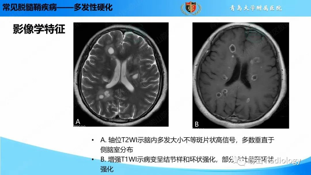 【PPT】脱髓鞘疾病-10