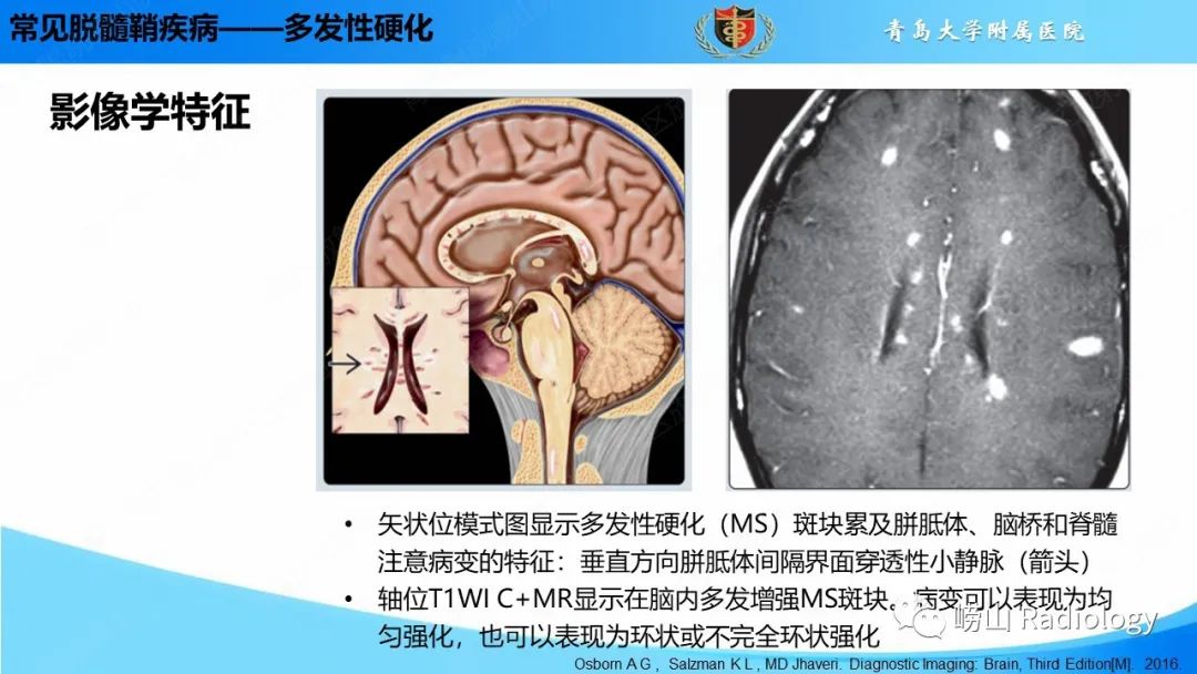 【PPT】脱髓鞘疾病-11