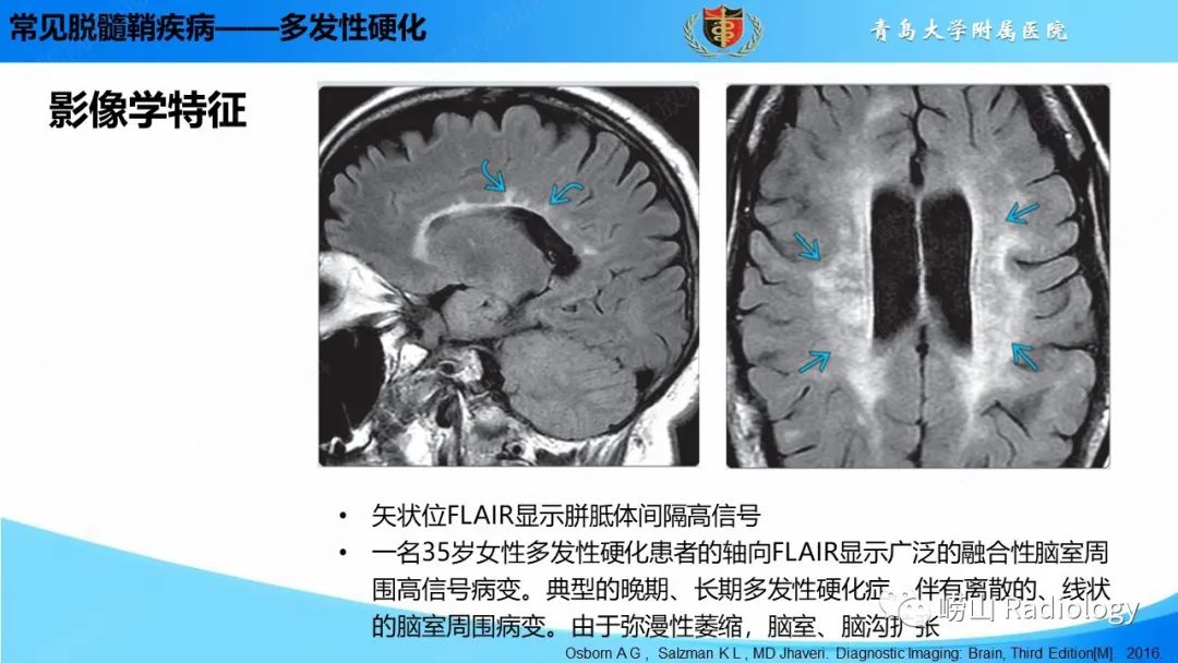 【PPT】脱髓鞘疾病-12