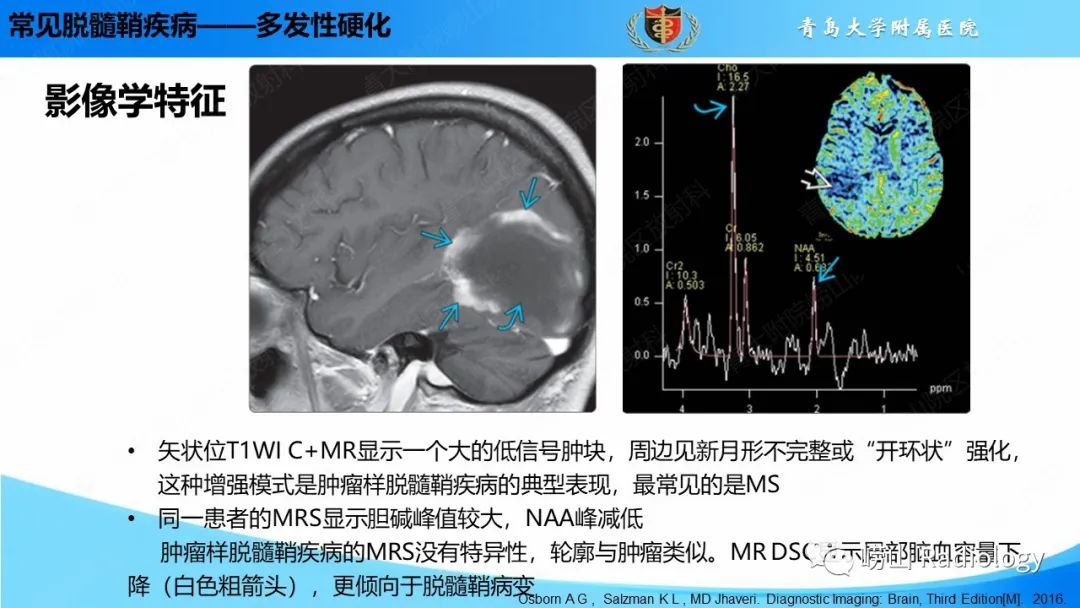 【PPT】脱髓鞘疾病-14