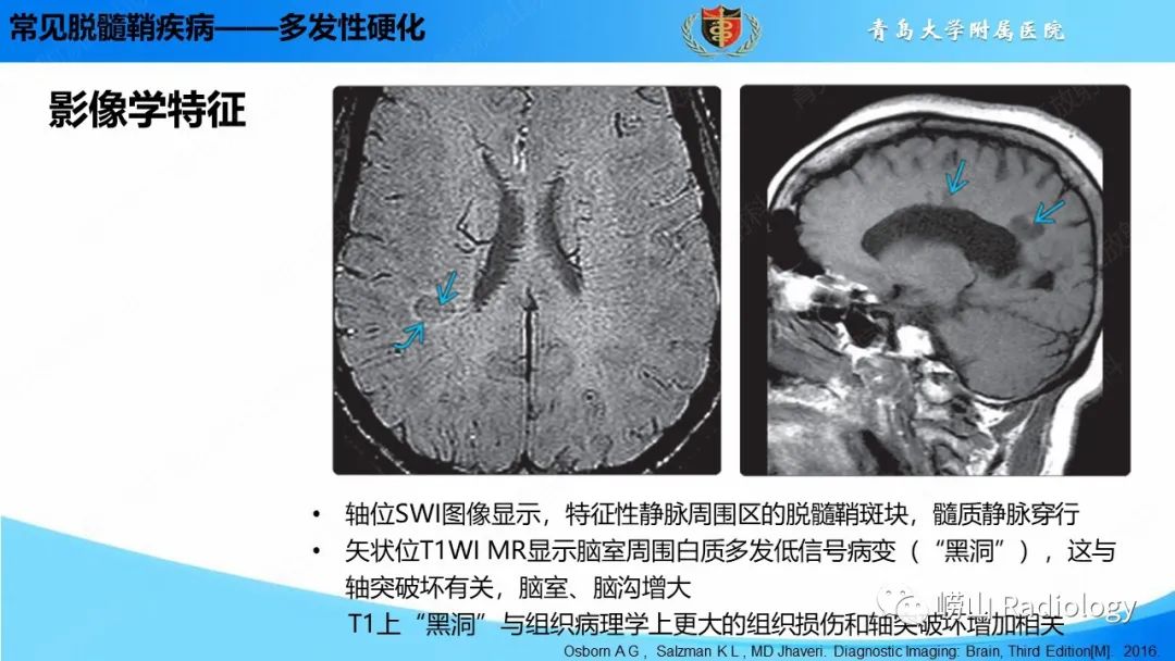 【PPT】脱髓鞘疾病-13