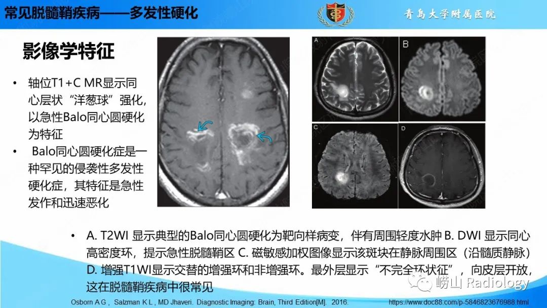 【PPT】脱髓鞘疾病-15