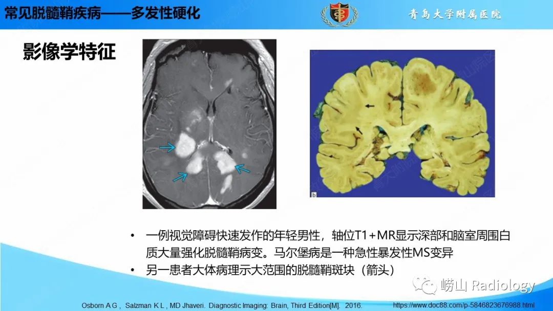 【PPT】脱髓鞘疾病-16