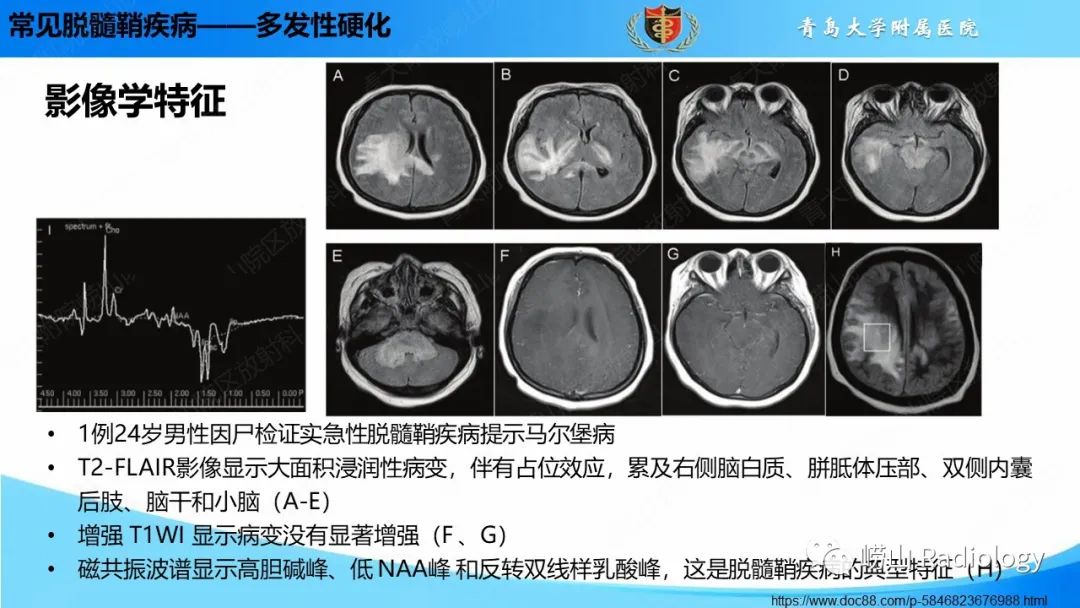 【PPT】脱髓鞘疾病-17