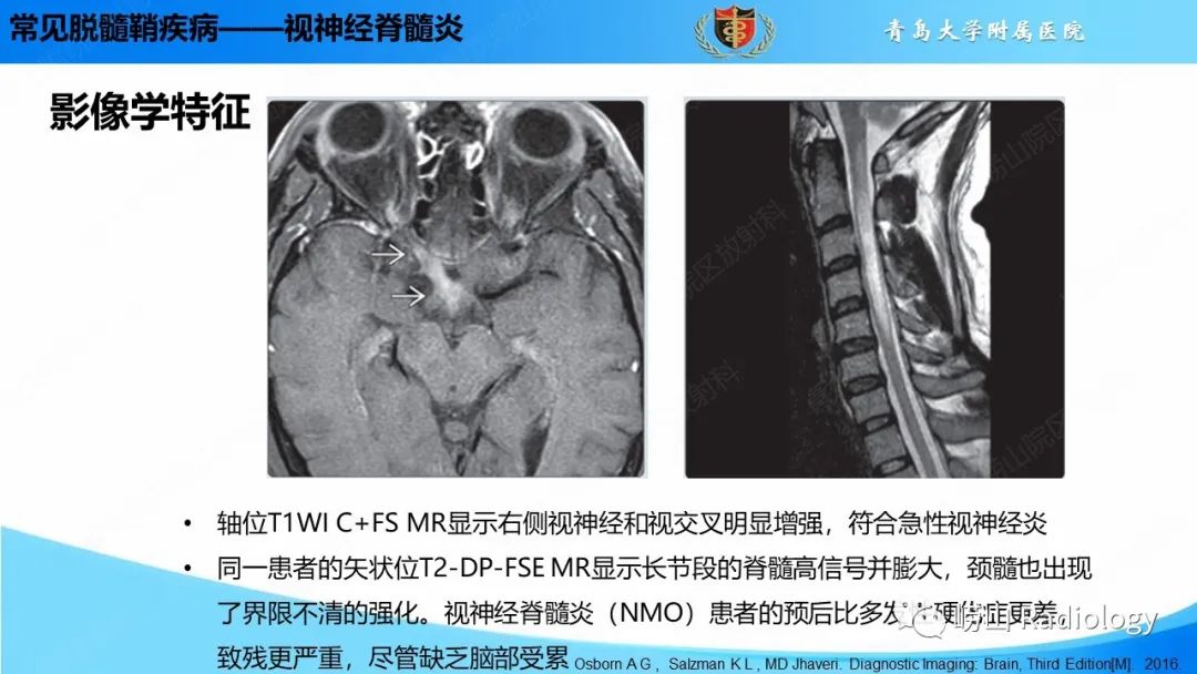 【PPT】脱髓鞘疾病-22