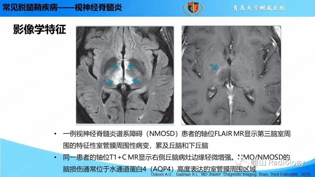 【PPT】脱髓鞘疾病-23