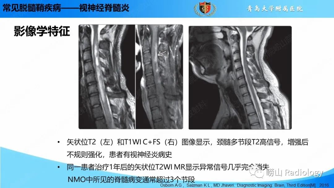 【PPT】脱髓鞘疾病-24