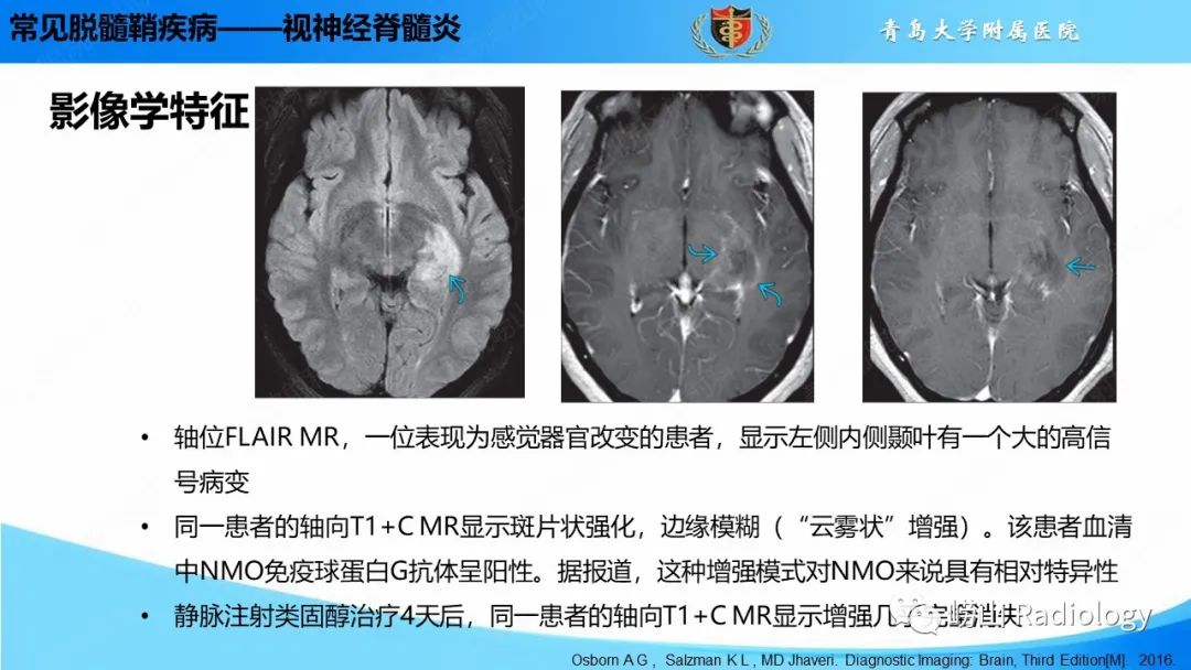 【PPT】脱髓鞘疾病-25