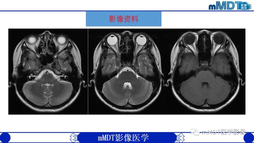 【PPT】双侧海绵窦结节病—神经结节病综述-5