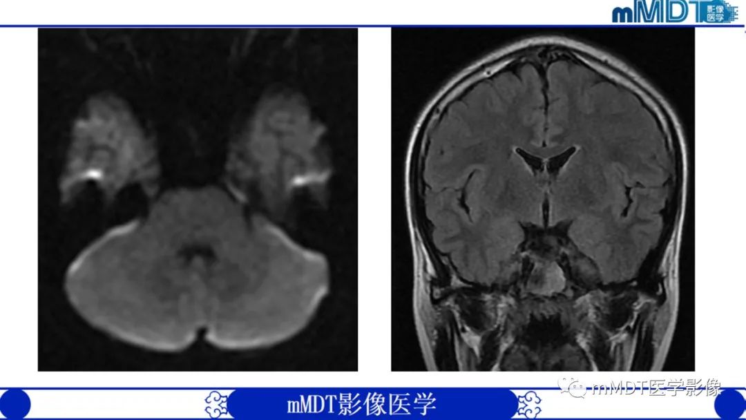 【PPT】双侧海绵窦结节病—神经结节病综述-6