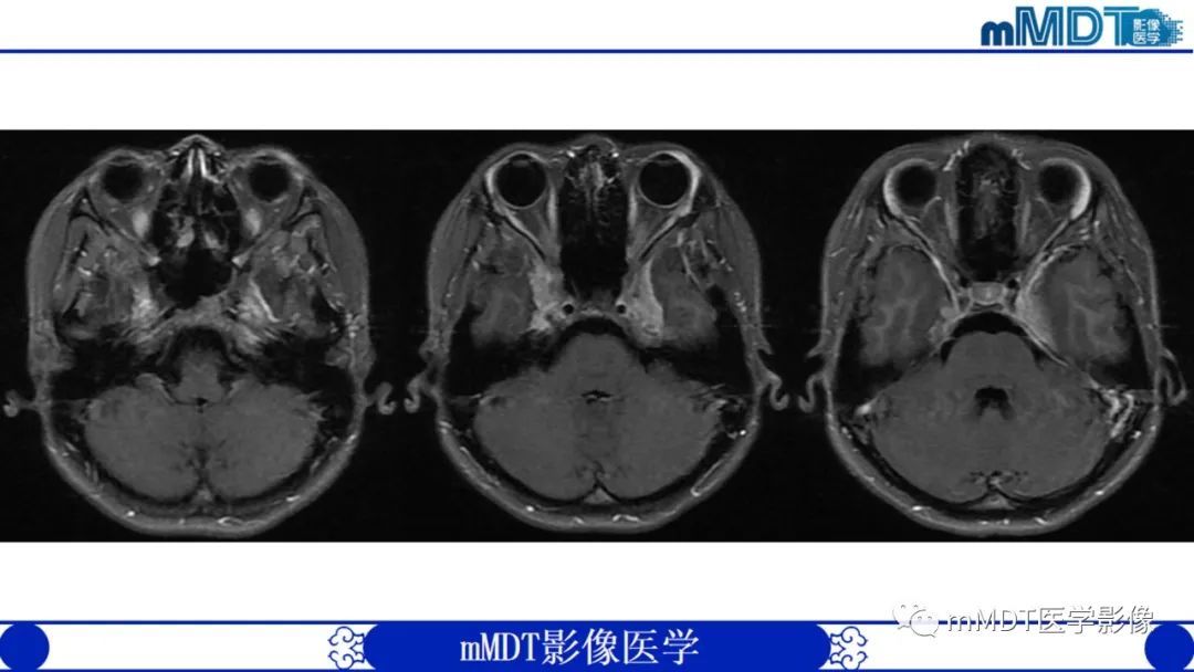 【PPT】双侧海绵窦结节病—神经结节病综述-7