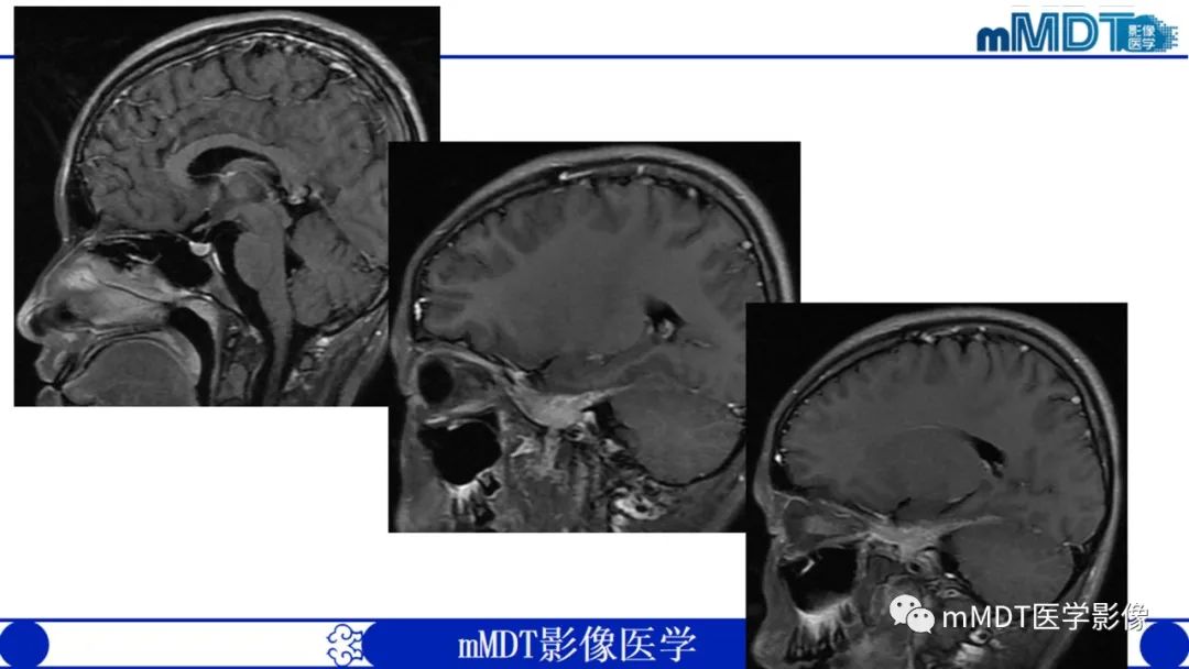 【PPT】双侧海绵窦结节病—神经结节病综述-9