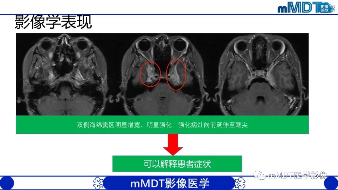 【PPT】双侧海绵窦结节病—神经结节病综述-11