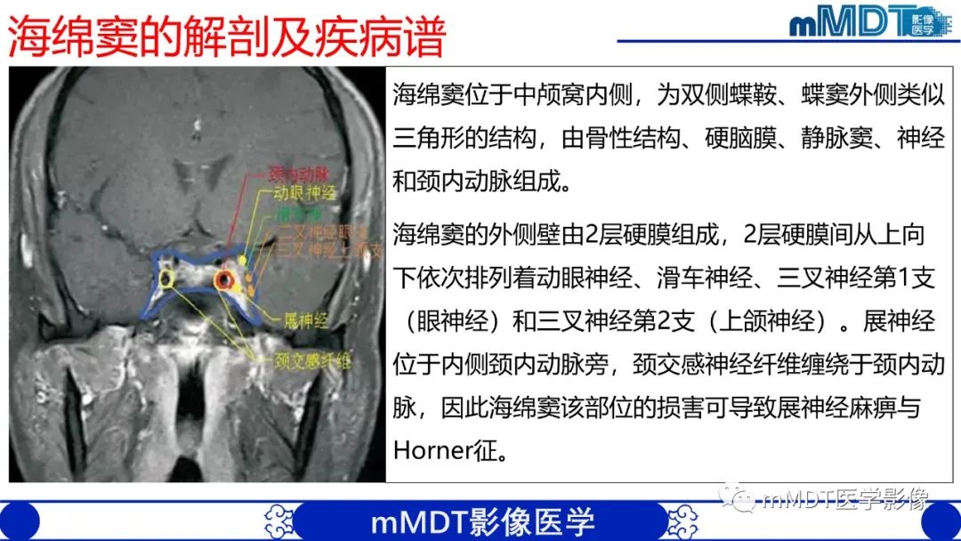 【PPT】双侧海绵窦结节病—神经结节病综述-12