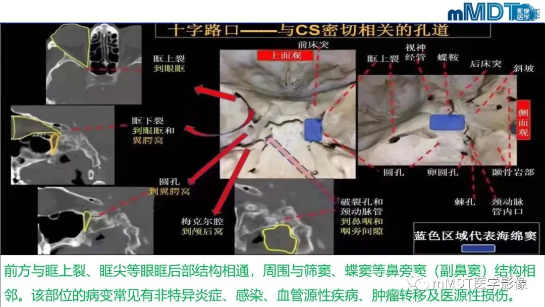 【PPT】双侧海绵窦结节病—神经结节病综述-14