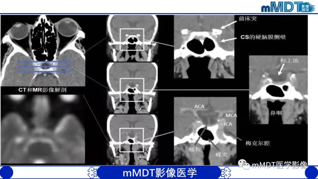 【PPT】双侧海绵窦结节病—神经结节病综述-16