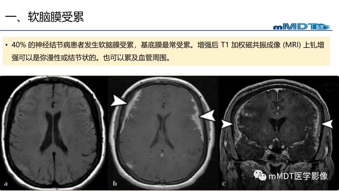 【PPT】双侧海绵窦结节病—神经结节病综述-23