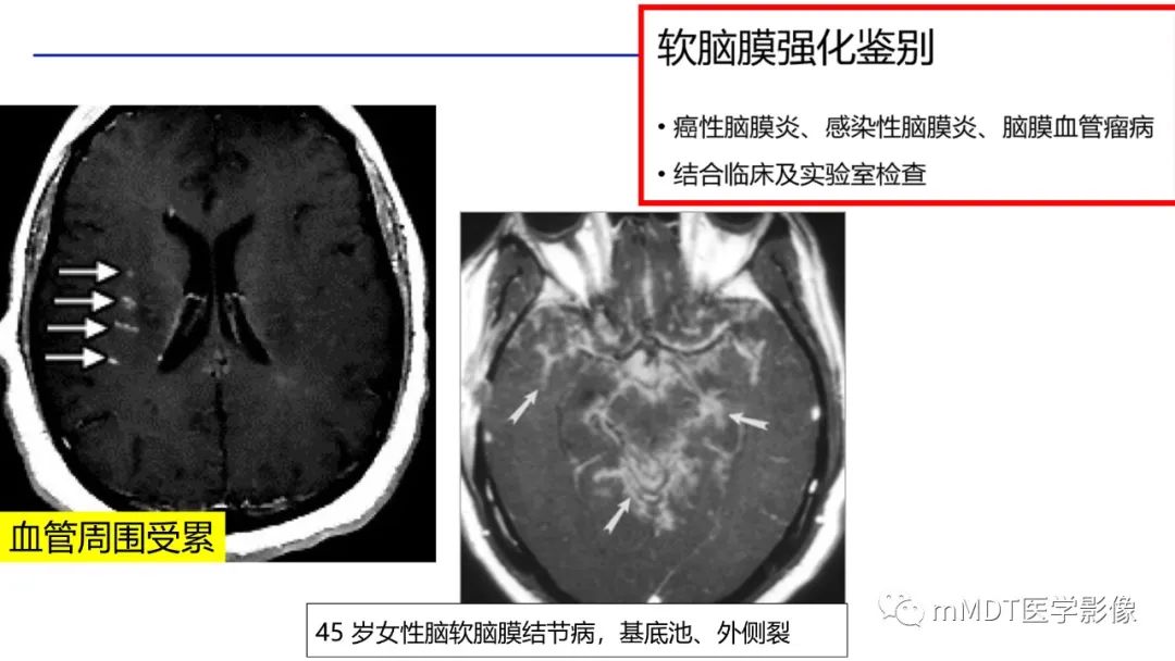 【PPT】双侧海绵窦结节病—神经结节病综述-24