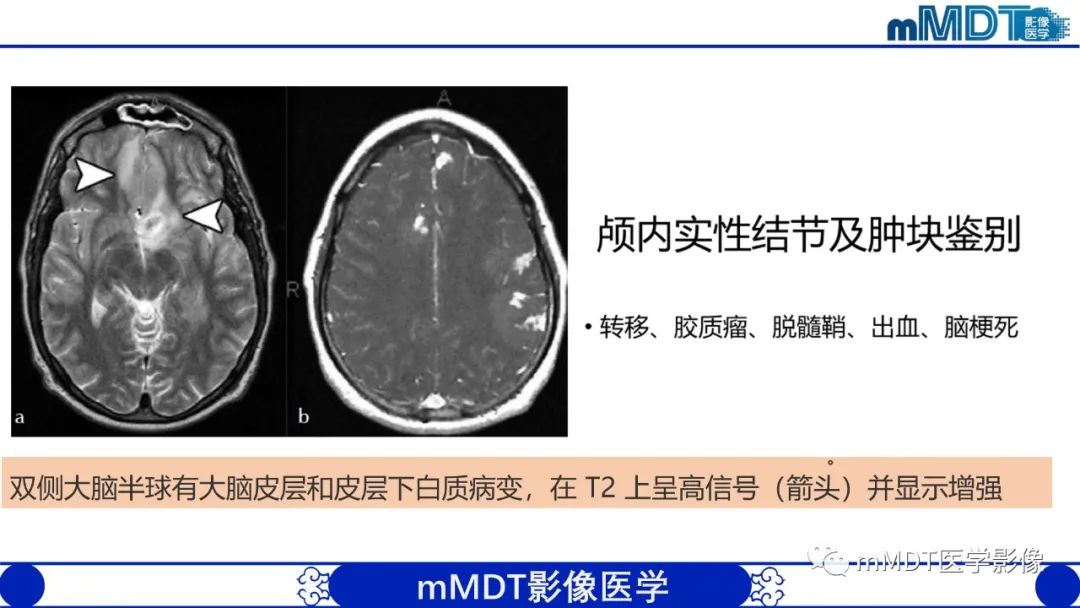 【PPT】双侧海绵窦结节病—神经结节病综述-26