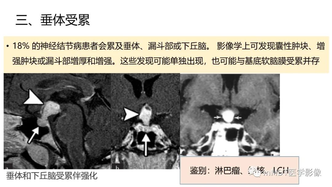 【PPT】双侧海绵窦结节病—神经结节病综述-27