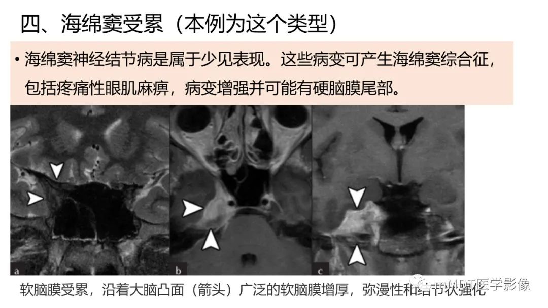 【PPT】双侧海绵窦结节病—神经结节病综述-28