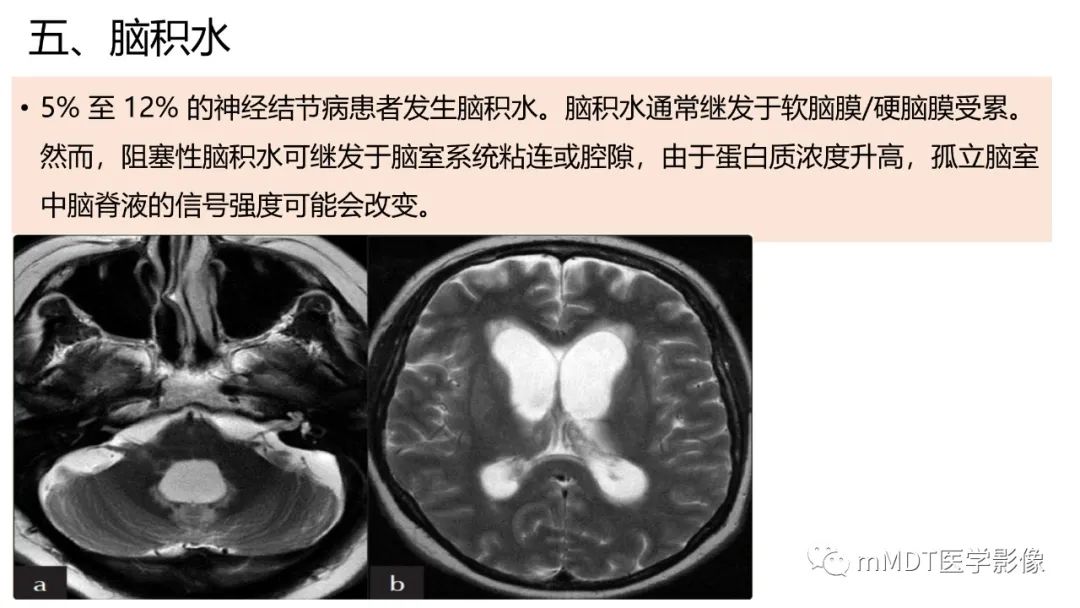 【PPT】双侧海绵窦结节病—神经结节病综述-29