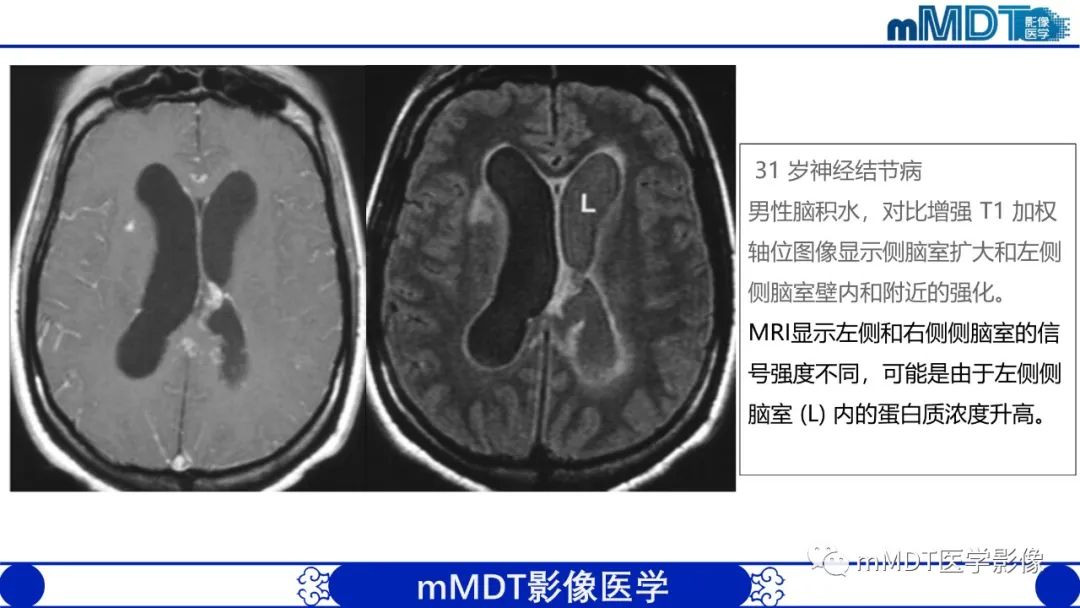 【PPT】双侧海绵窦结节病—神经结节病综述-30