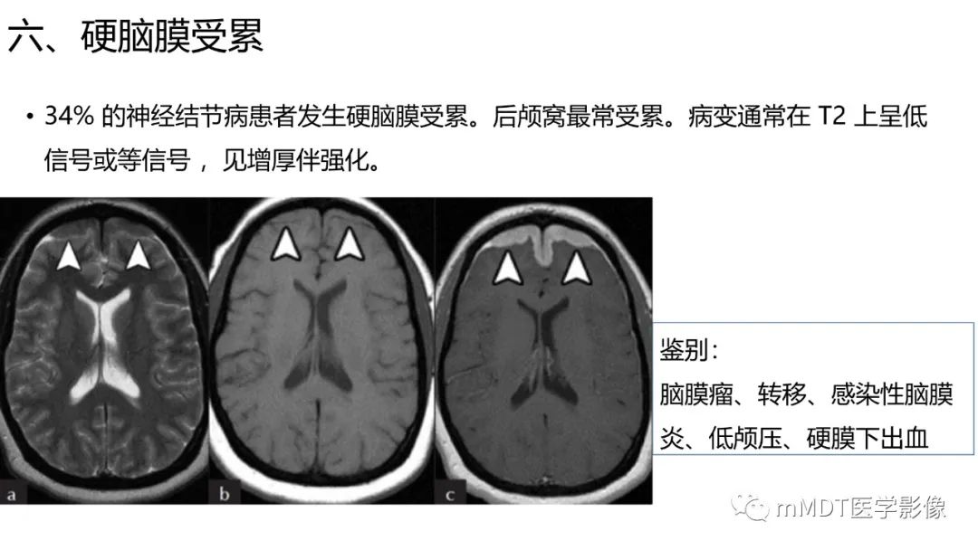 【PPT】双侧海绵窦结节病—神经结节病综述-31