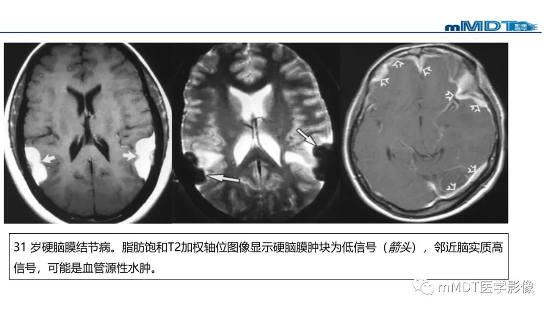 【PPT】双侧海绵窦结节病—神经结节病综述-32