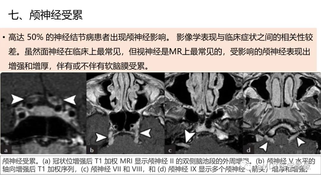 【PPT】双侧海绵窦结节病—神经结节病综述-33