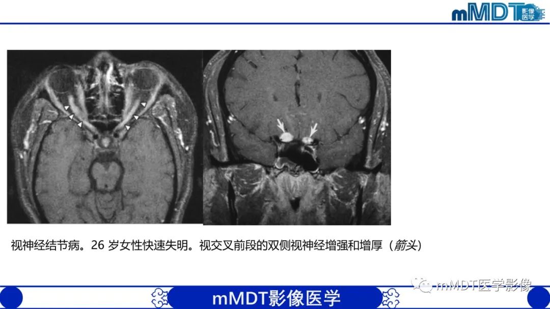 【PPT】双侧海绵窦结节病—神经结节病综述-34