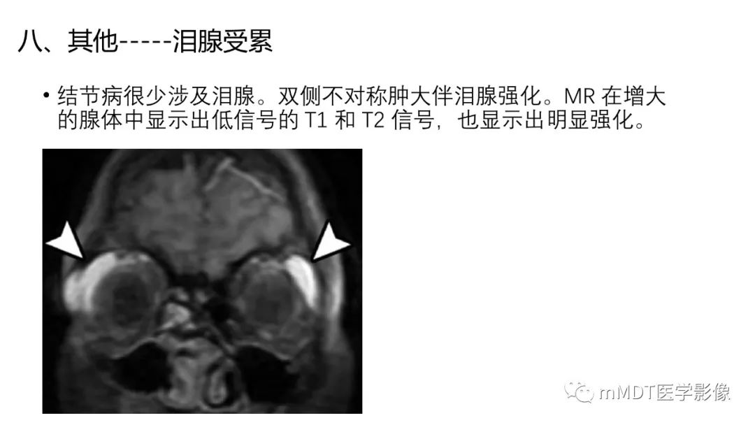 【PPT】双侧海绵窦结节病—神经结节病综述-35