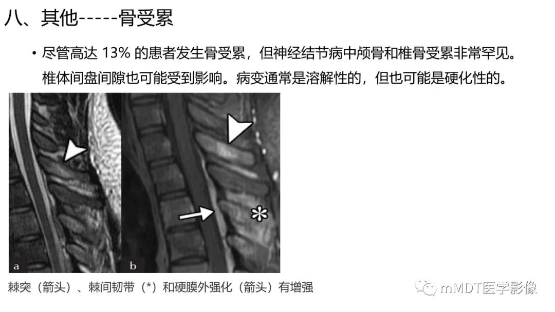 【PPT】双侧海绵窦结节病—神经结节病综述-36