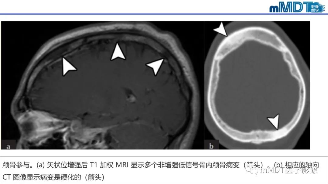 【PPT】双侧海绵窦结节病—神经结节病综述-37